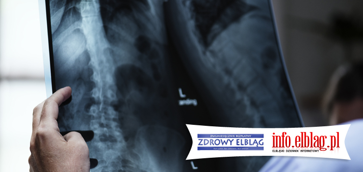 Zdrowy Elbląg: Złodziejka kości