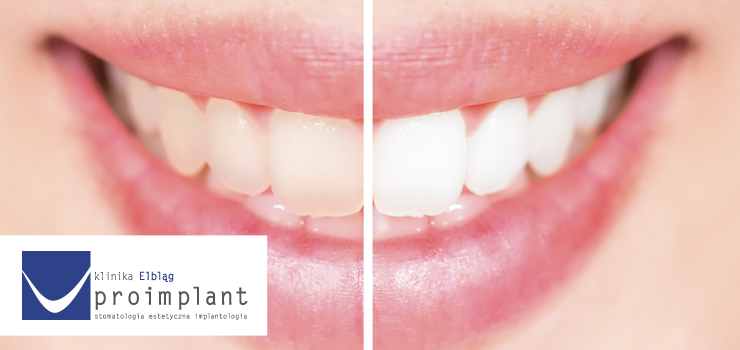 Wybielanie zębów