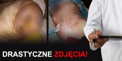 Skandal w elbl�skim szpitalu! W wypisie by�o "stan zadowalaj�cy", a mama krzycza�a z b�lu.  [Uwaga drastyczne zdj�cia]
