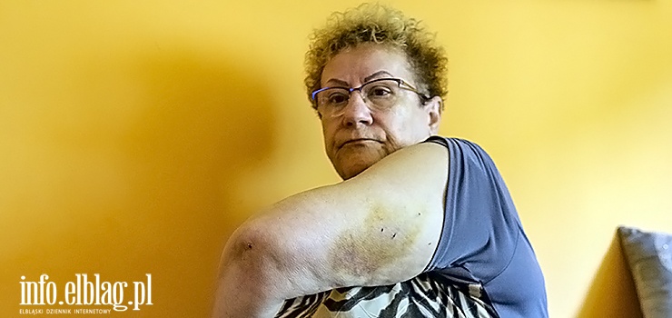 To nie były miłe mruczki. Elblążanka zaatakowana i pogryziona przez koty