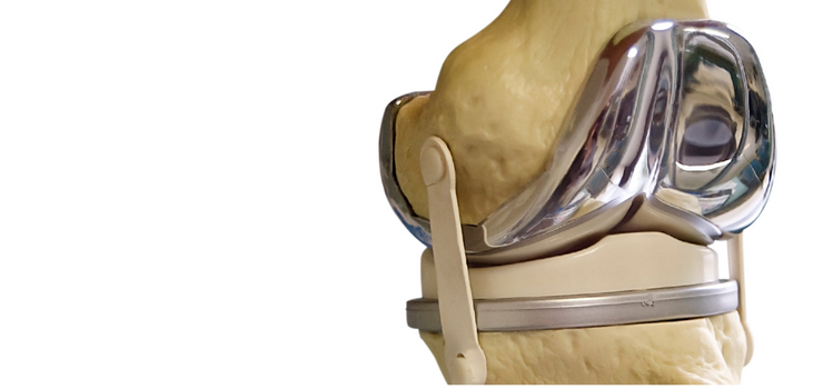 Kiedy warto skorzystać z endoprotezy kolana?